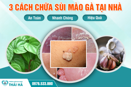 3 Cách Chữa Sùi Mào Gà Tại Nhà Nhanh Chóng, An Toàn Và Hiệu Quả