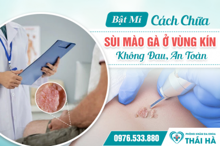 Bật Mí Cách Chữa Sùi Mào Gà Ở Vùng Kín Không Đau, An Toàn
