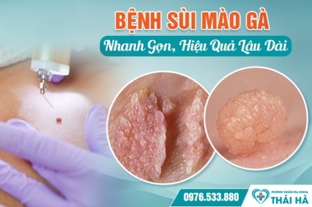 Bật Mí Phương Pháp Chữa Trị Sùi Mào Gà Nhanh Gọn, Hiệu Quả Lâu Dài
