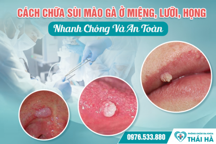 Cách Chữa Sùi Mào Gà Ở Miệng, Lưỡi, Họng Nhanh Chóng Và An Toàn