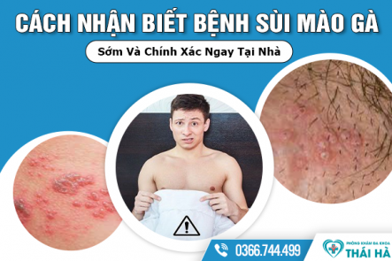 Cách Nhận Biết Bệnh Sùi Mào Gà Sớm Và Chính Xác Ngay Tại Nhà