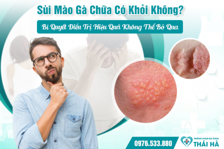 Sùi Mào Gà Chữa Có Khỏi Không? Bí Quyết Điều Trị Hiệu Quả Không Thể Bỏ Qua