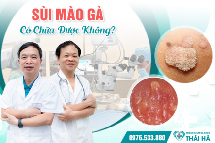 Sùi Mào Gà Có Chữa Được Không?