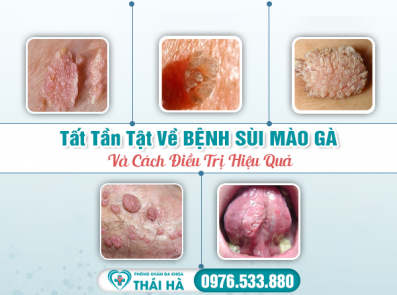 Tất Tần Tật Bệnh Sùi Mào Gà Và Cách Điều Trị Hiệu Quả