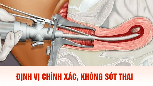 Định vị chính xác, không sót thai